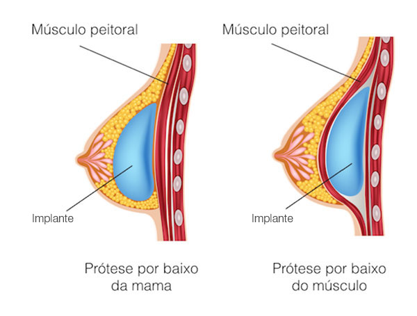 Implante de prótese mamária