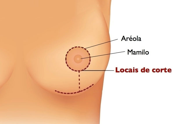 Mamoplastia redutora