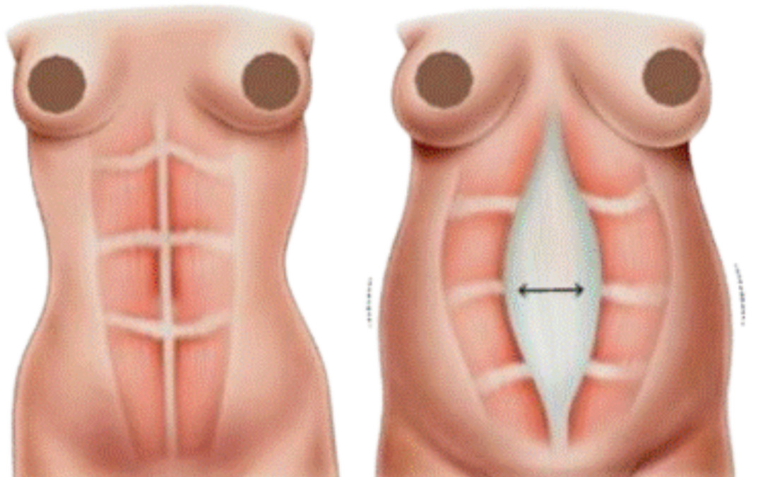 O que é diástase abdominal, como saber se tenho e qual a solução