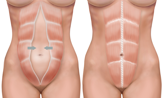 abdominoplastia