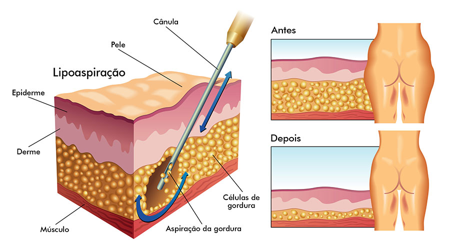 lipoaspiração