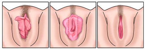 Ninfoplastia