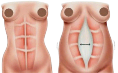 O que é diástase abdominal, como saber se tenho e qual a solução?